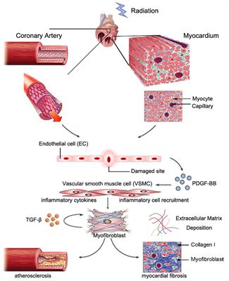 The Role of NLRP3 Inflammasome in Radiation-Induced Cardiovascular Injury